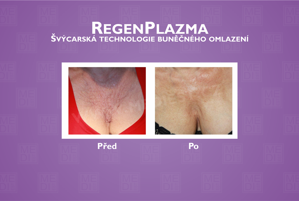 regenplazma