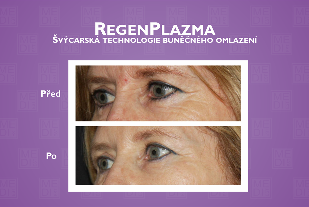 regenplazma